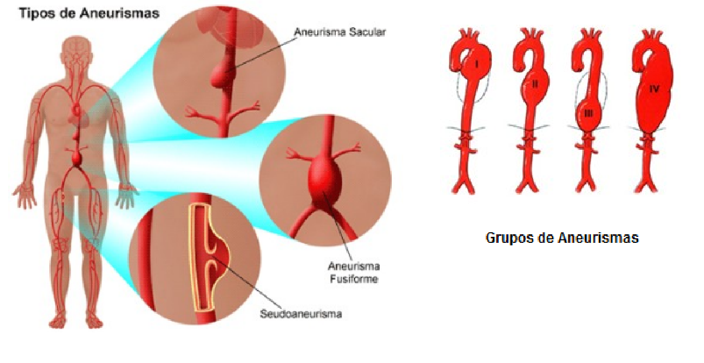 Aneurismas Aorta Toracica Aneurismas Mx